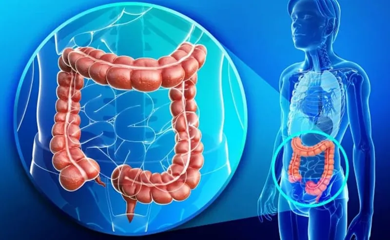 Virtual Colonoscopy Deteksi Kanker Usus